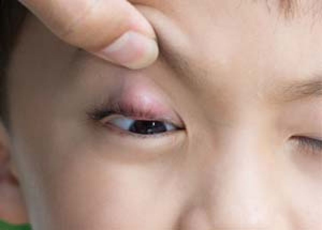 Лечение ячменя на глазу. Ясень глазами детей. Ячмень на глазу у реьенк.