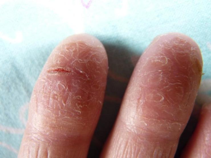 Трескается кожа на пальцах рук: почему появляются трещины и что делать .