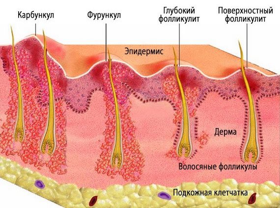 Фурункул на попе фото