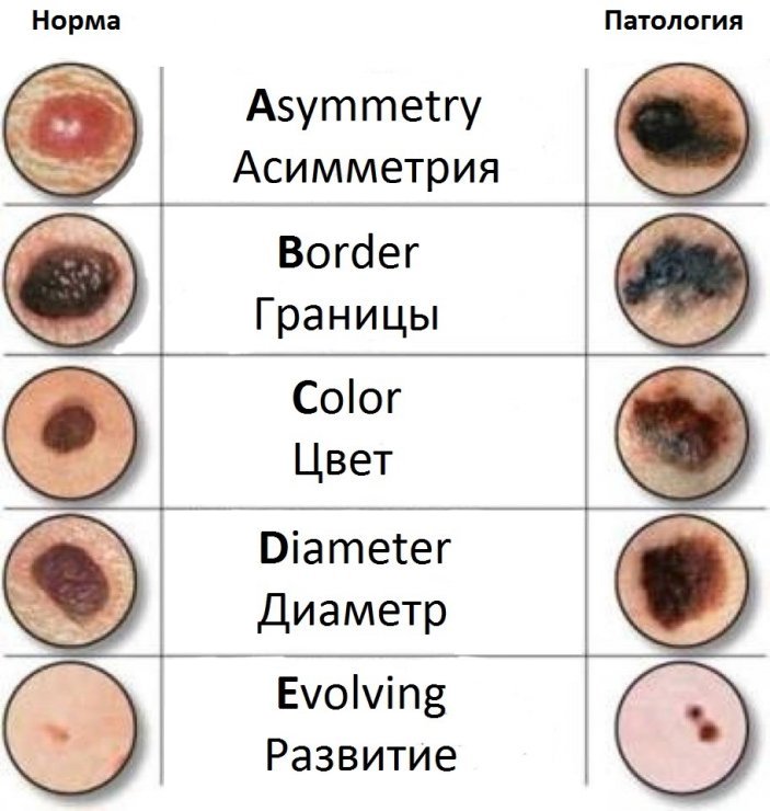 Злокачественная меланома фото на лице