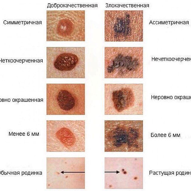 Показать злокачественные родинки фото