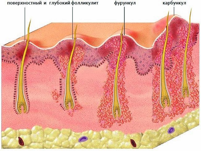 Фурункулез причины и лечение фото