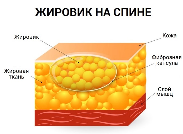 Жировик на голени фото