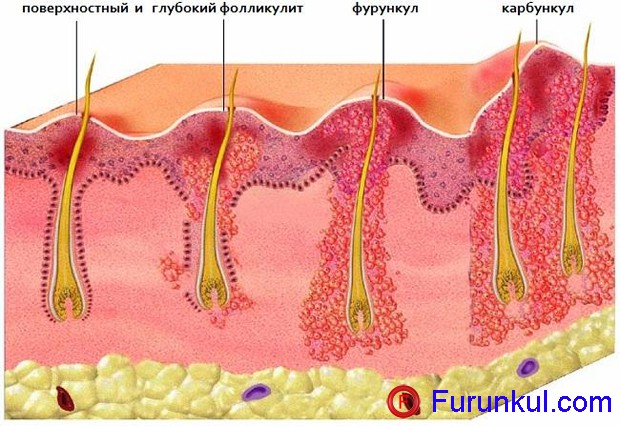 Этапы созревания фурункула фото