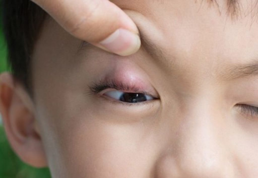 Как вылечить ячмень у ребенка на глазу. Халязион халязион халязион. Ячмень на глазу уребегка. Ячмень верхнего века у ребенка.