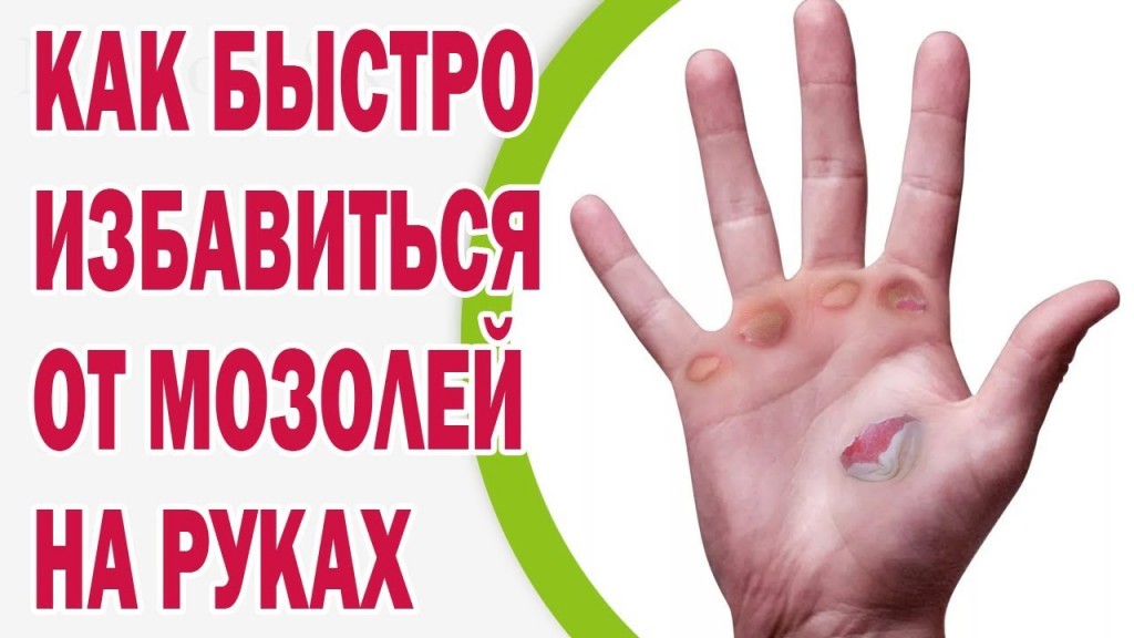 Как избавиться от мозолей на пальцах рук: традиционные методы лечения ...