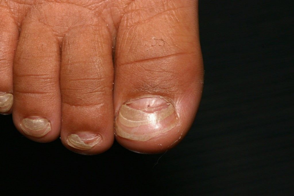 Подногтевая меланома, рак ногтевой пластины: излечение, симптомы .