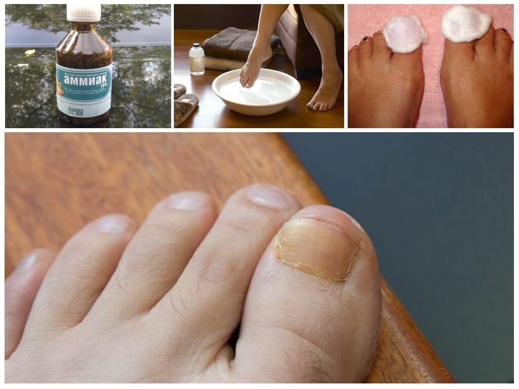 Лечение ногтевого грибка на ногах. Нормотрофический онихомикоз. Онихомикоз ( обработка грибковых ногтей).