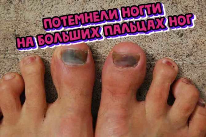 Грибок ногтя на большом пальце ноги: фото и лечение