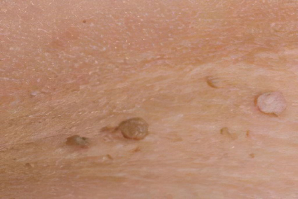 Фиброма кожи - виды, причины и симптомы 