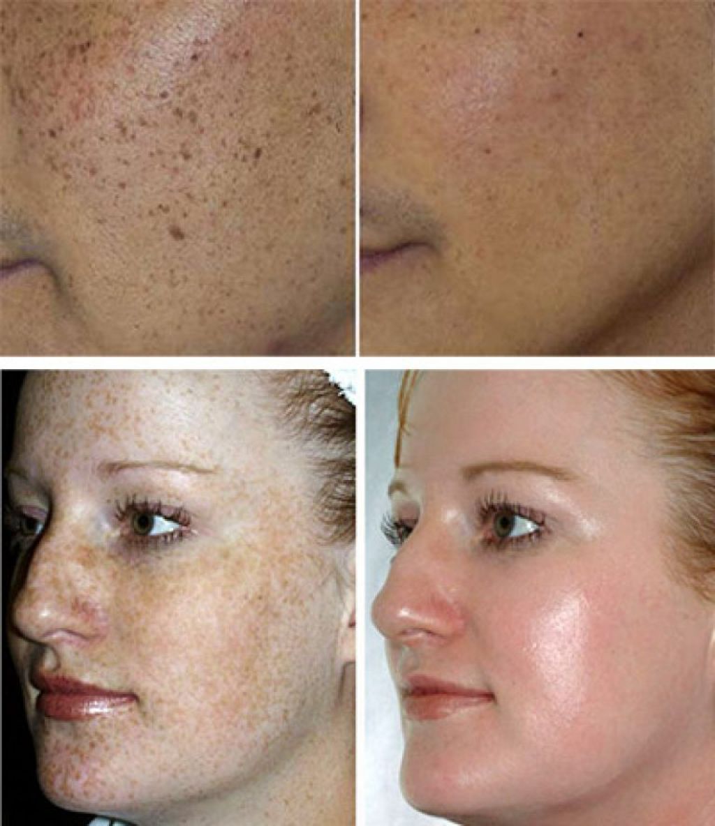 Как убрать на лице. Пигментация на лице до и после. Лазер от пигментации на лице. Отбеливание кожи лица лазером.