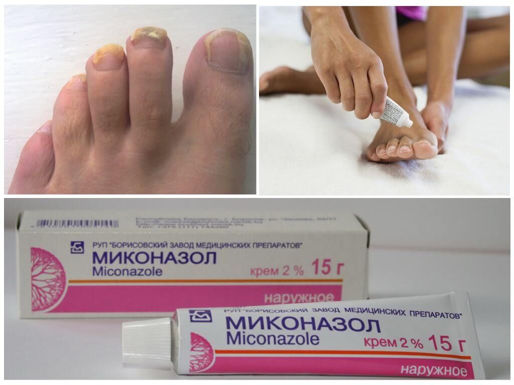 Грибок стопы эффективные препараты. Миконазол от грибка ногтей. Миконазол мазь от грибка. Крем от грибка ногтей миконазол. МАЗ против грибка для ног мазь.