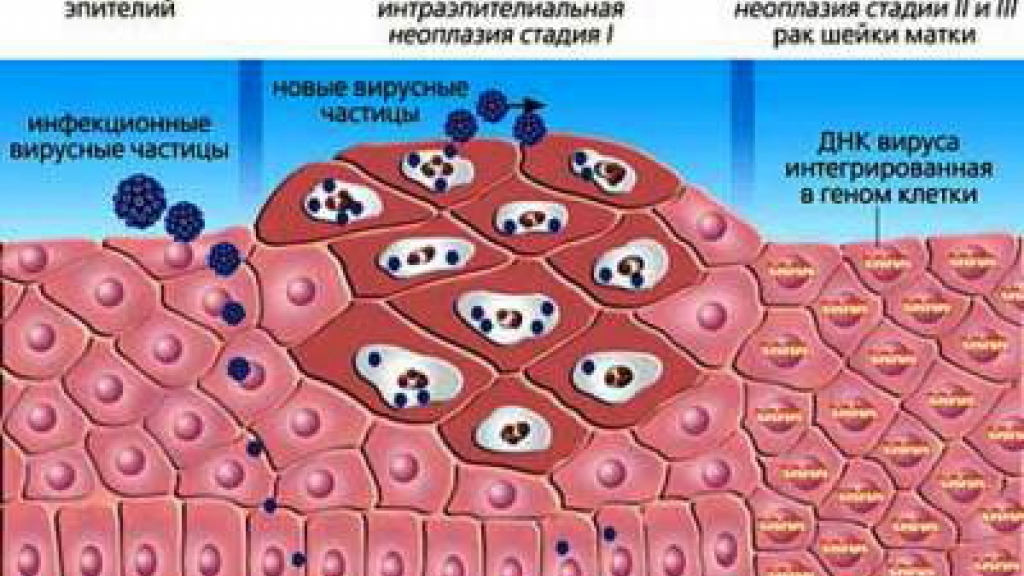 Микропапилломатоз фото у женщин