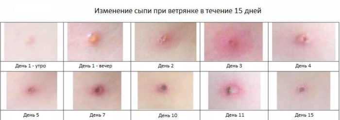 Можно ли второй раз заболеть ветрянкой во взрослом возрасте?