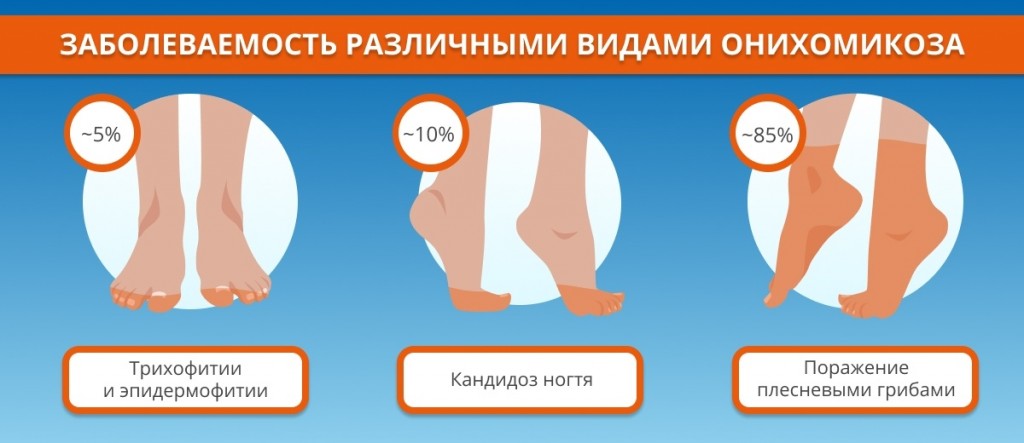 Лечение запущенной формы грибка ногтей народными средствами