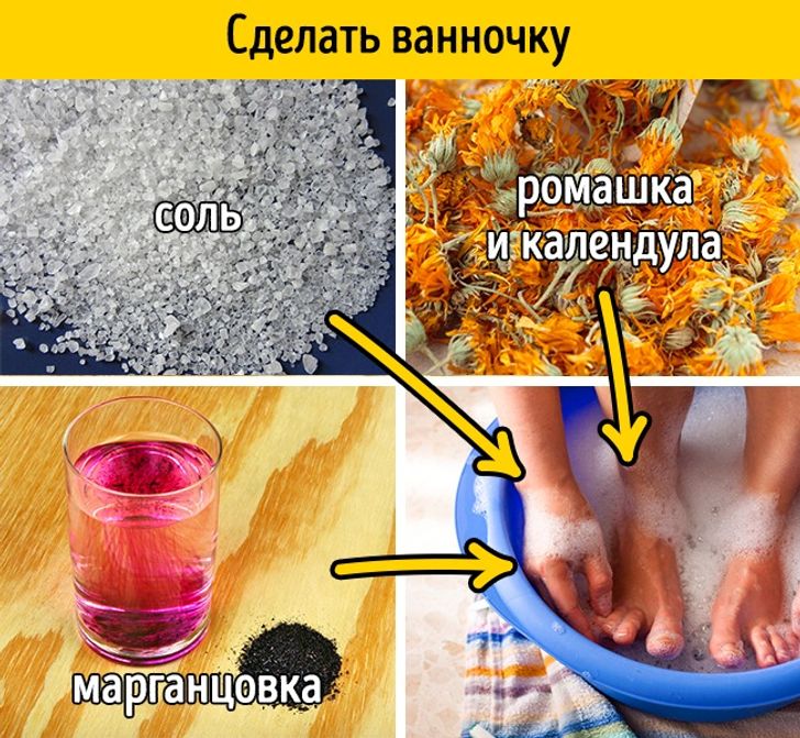 Водяная мозоль | Симптомы | Диагностика | Лечение .ru