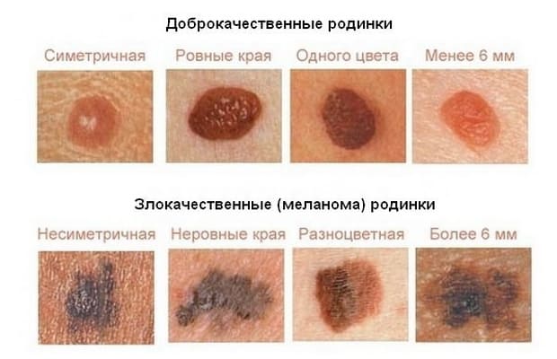 Кератома: фото, симптомы, лечение, опасность и диагностика - ГБУЗ МО ...