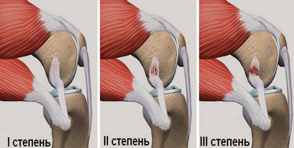Операция на мышцах ног. Внутрикапсулярные связки коленного сустава. Микроразрыв связок коленного сустава. Тендинит сухожилия подколенной мышцы. Ушиб подколенного сухожилия.