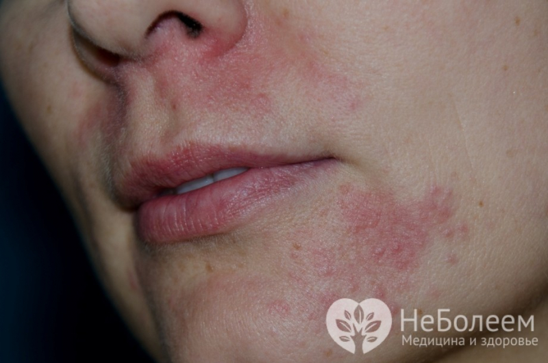 Пероральный дерматит фото на лице у женщин