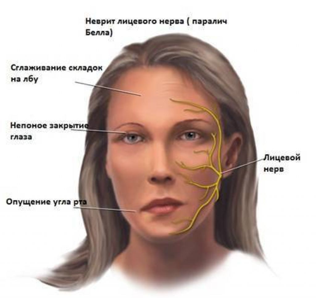 Лечения лицевой невропатия. Неврит тройничного нерва симптомы. Паралич тройничного нерва симптомы.