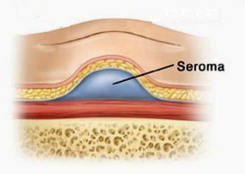 Серома после абдоминопластики фото