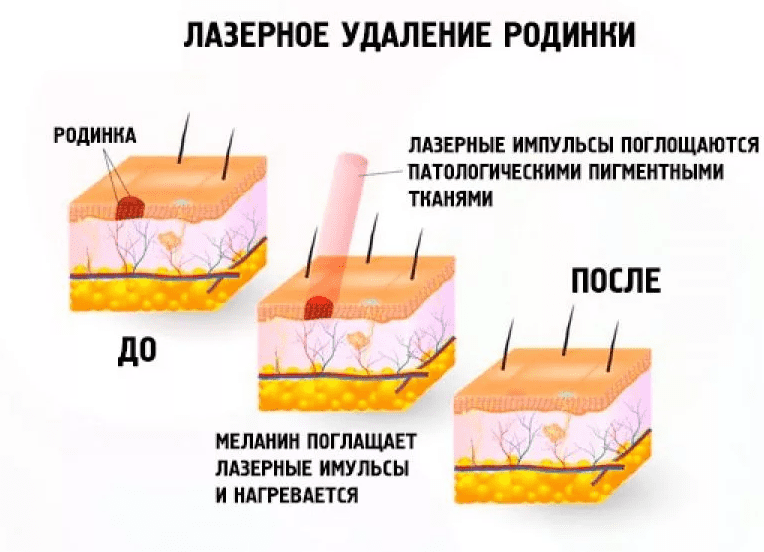 Удаление большого сальника последствия