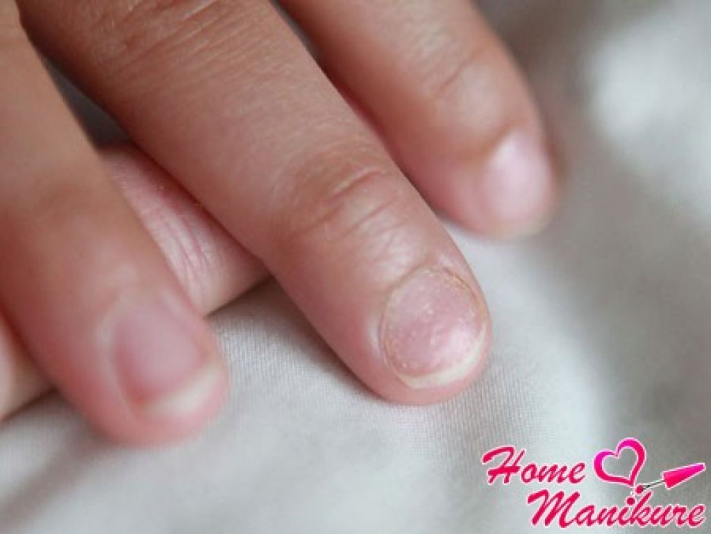 Почему ногти стали ребристыми вертикально. Деформация ногтей на руках у ребенка. Деформированные ногти на руках.