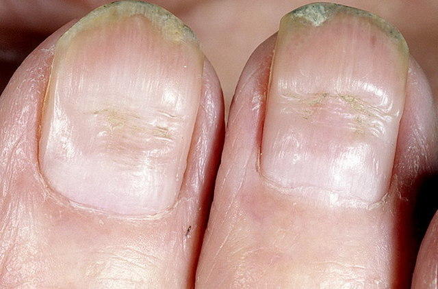 Определение заболевания по ногтям на руках фото