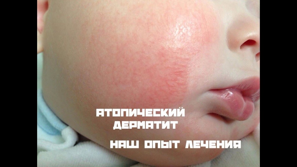 Как выглядит аллергический дерматит у детей фото