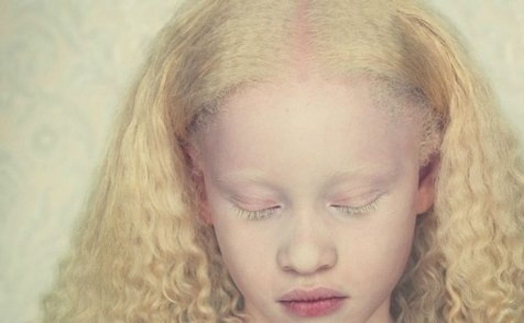 Альбинизмом страдают. Глазокожный альбинизм Тип 1а. Люди альбиносы с красными глазами. Альбинизм это геномная мутация.
