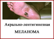 Акрально-лентигинозная меланома.