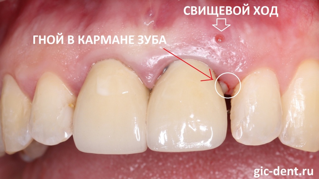 Гнойник на ноге фото