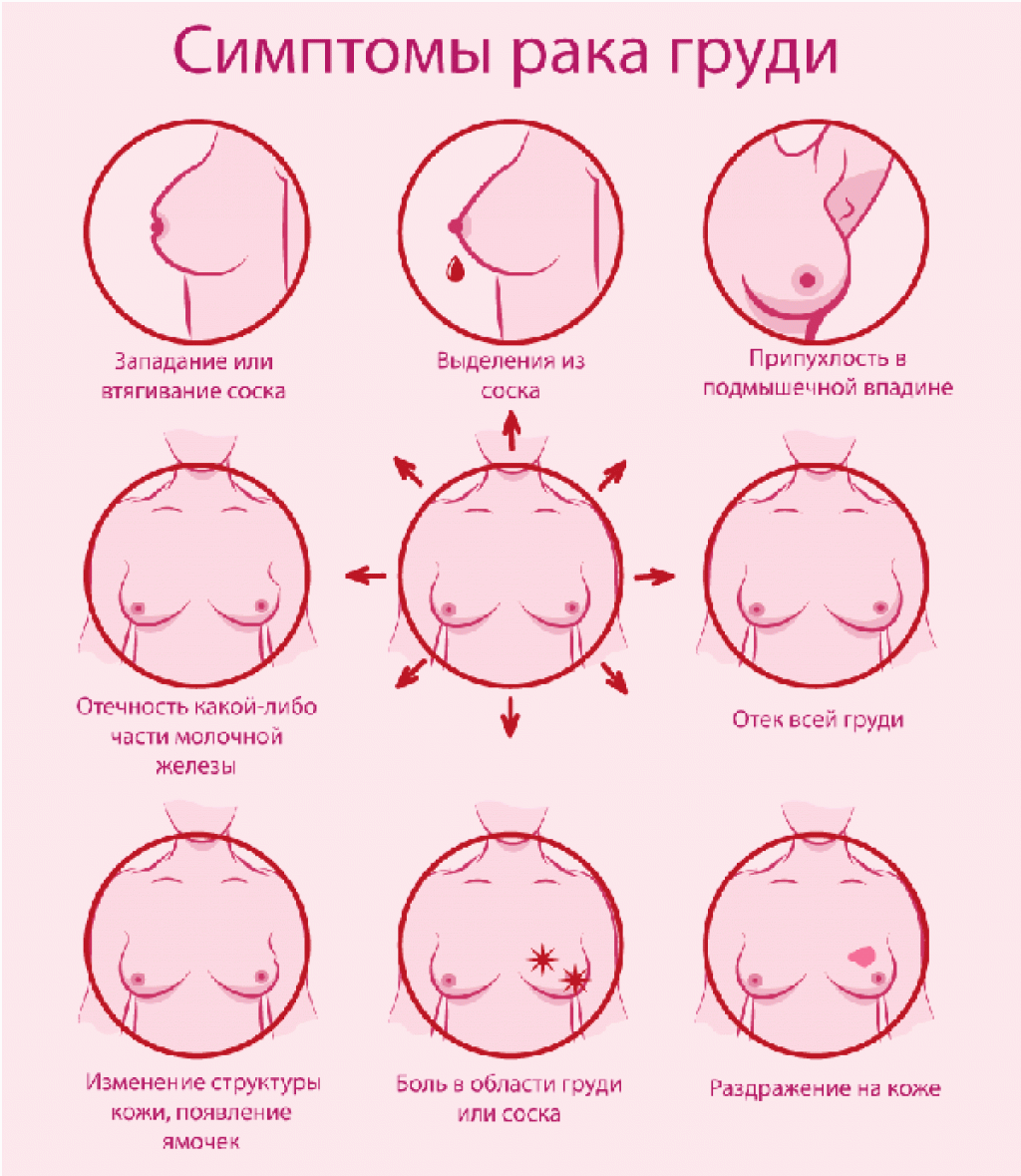 изменения в груди при беременности на раннем сроке фото 115