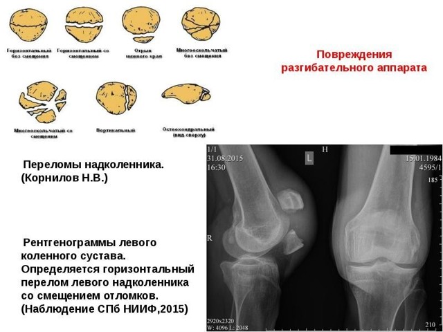 Вывих надколенника карта вызова