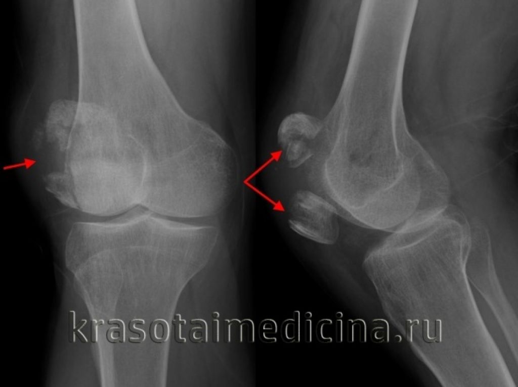 Перелом надколенника операции. Гемартроз коленного сустава рентген. Перелом надколенника рентген. Гемартроз на рентгене колена. Перелом надколенника мкб 10.