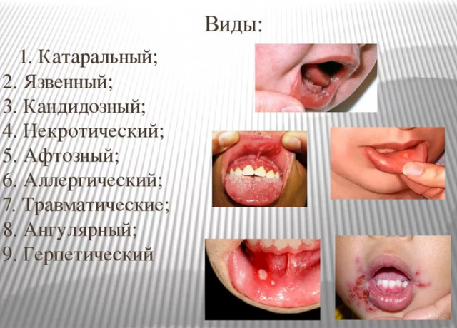 Что такое стоматит у детей фото