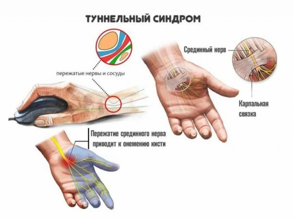 Схема подготовки к колоноскопии мовипрепом