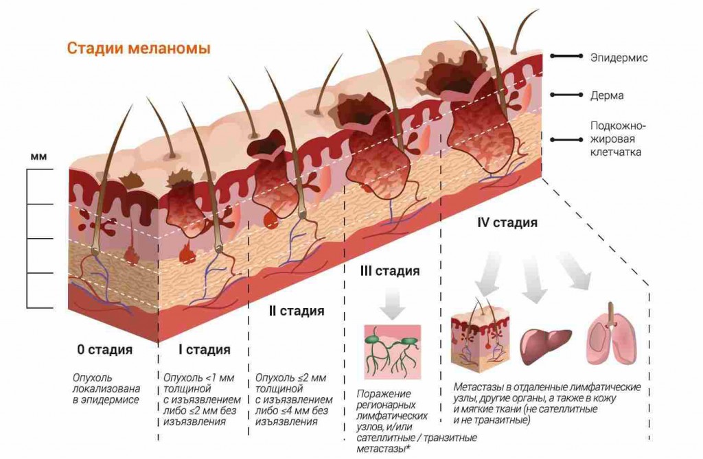 Меланома лечение фото симптомы и лечение