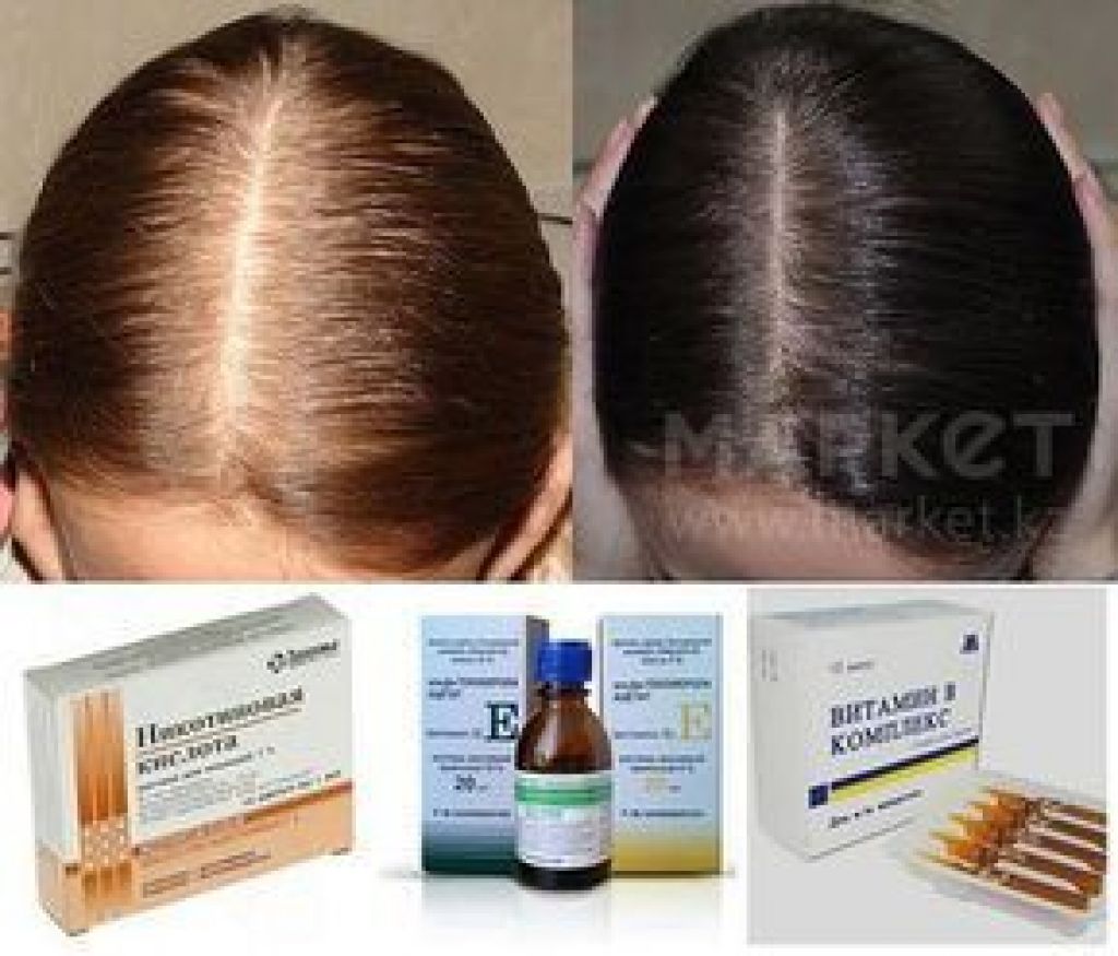 Выпадают волосы таблетки. Витамины для волос от выпадения. Выпадение волос витамины. Эффективные витамины для волос от выпадения. Витамины для волос от облысения у женщин.