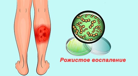 Симптомы и лечение рожистого воспаления: ноги, руки, кожи лица