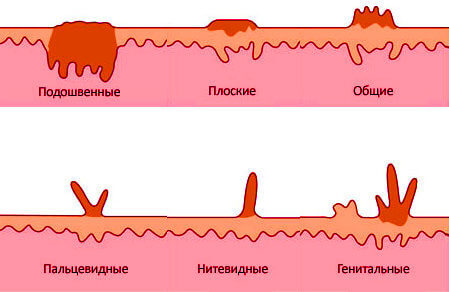 Крупные папилломы фото