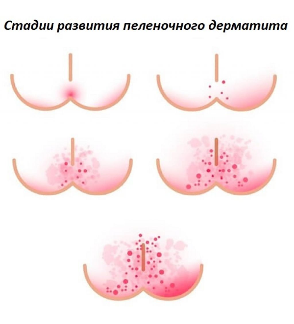 Пеленочный дерматит у грудничка