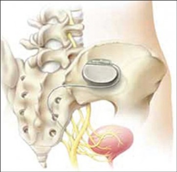 Методы лечения эректильной дисфункции у пациентов со спинальной травмой