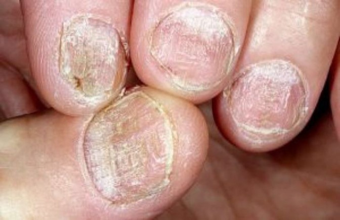 Псориаз ногтей (псориатическая ониходистрофия) | Лечение псориаза авторской методикой доктора Огневой. Как и где можно вылечить псориаз по уникальному методу