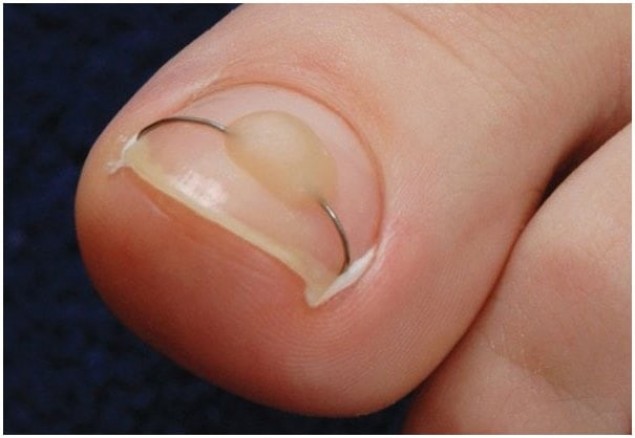 Способы лечения вросших ногтей