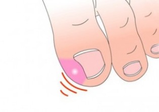Клинические характеристики проявления вросшего ногтя