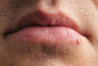 Причины появления белых точек на губах