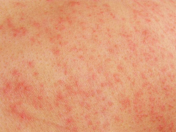 Как отличить потницу от аллергии — рекомендации «Ла-Кри»
