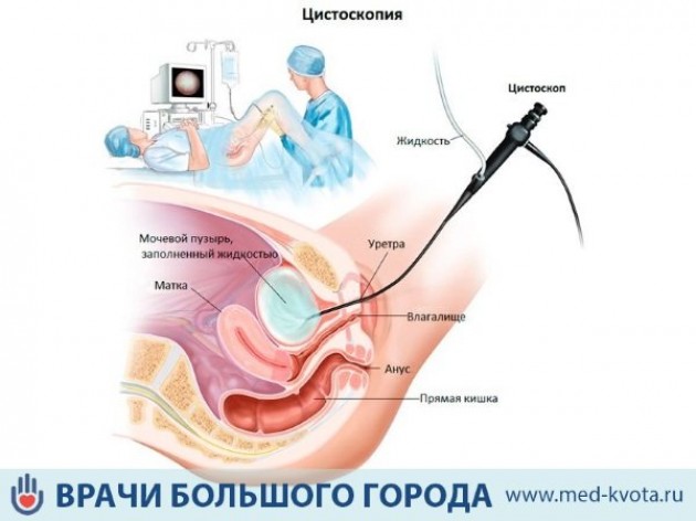 Стадии рака уретры (мочеиспускательного канала)