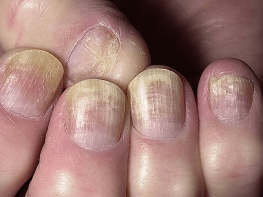 Грибковое поражение ногтевых пластин или микоз